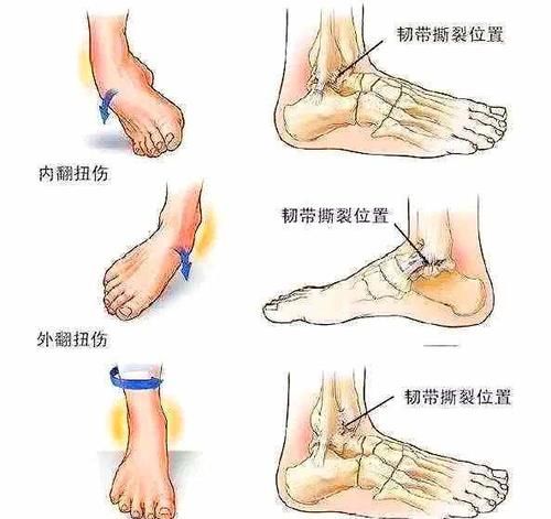  『韧带撕裂』崴脚脖子只要能走就没大事儿？医生辟谣：韧带损伤请不要忽视！
