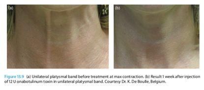 颈纹咋这么显老?别怪我没提醒，再晚就来不及了