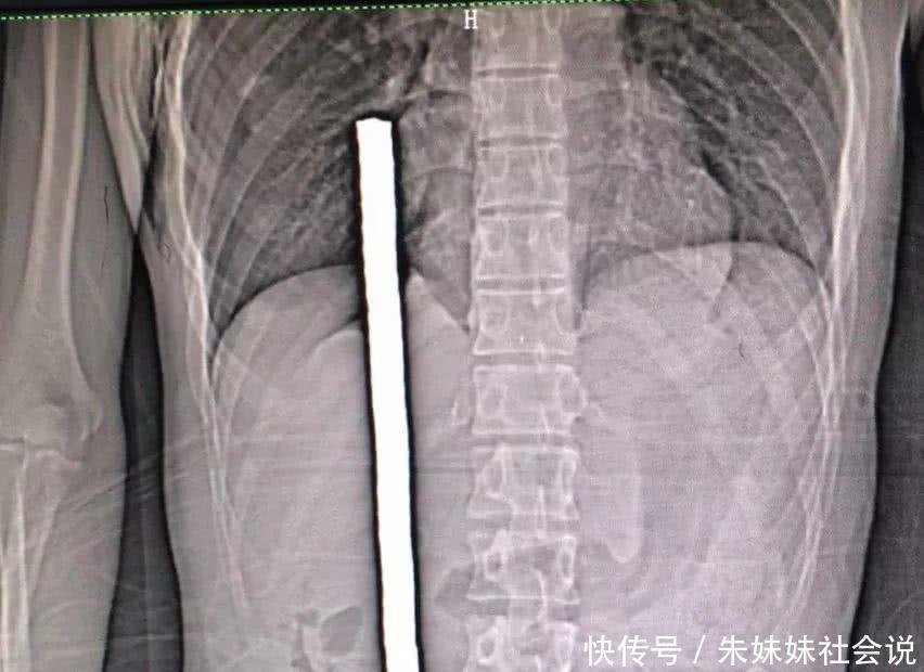揪心!1米多长钢筋从下体穿入,直逼心脏!