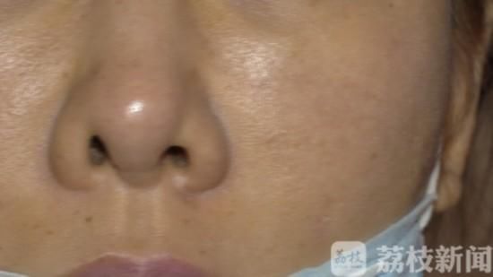  「修复」女子在南京施尔美整形医院隆鼻后鼻子歪了 修复后更歪了
