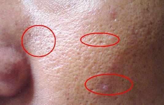 脸上螨虫无法无天?