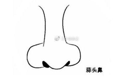  『鼻翼软骨』那么哪些鼻型适合做隆鼻手术