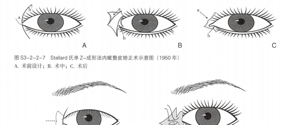  「睑皮肤松弛」眼部美容仪对去眼袋有用吗
