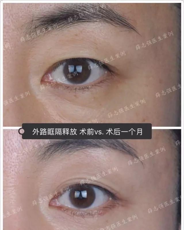  [熬夜]明明说好一起熬夜的，为什么就只有你熬出了眼袋+黑眼圈？