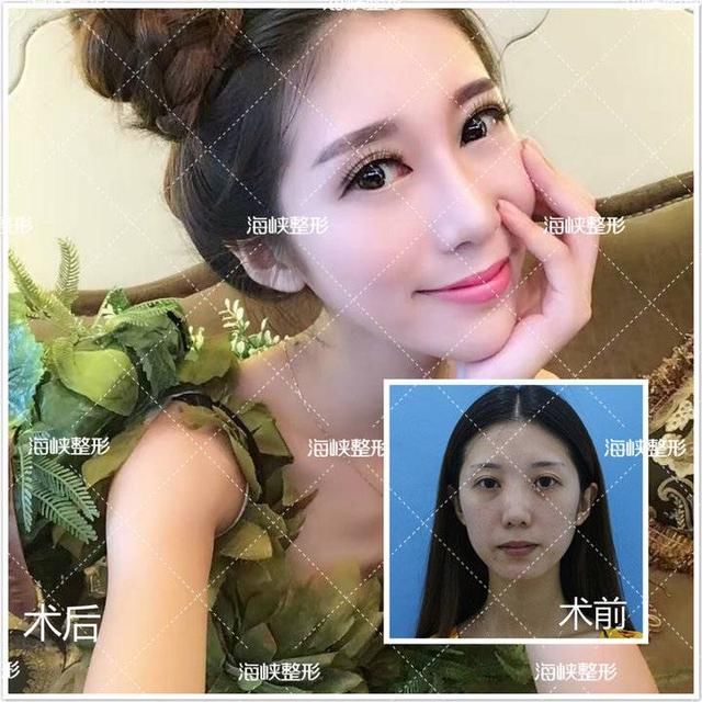 【咬肌肥大】明明打了瘦脸针，脸为什么还这样大？