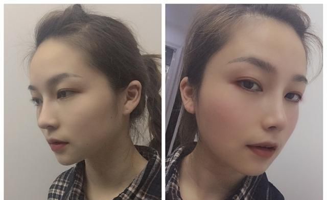  #术后#隆鼻真的有用吗？鼻综合术后六个月记录，这完全不是一个人！