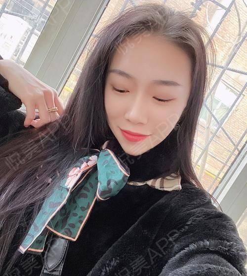  角度■我的下额角磨骨后形成第二个角度,这算不算磨骨失败?