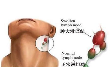 全身廣泛的淋巴結腫大,以急性淋巴細胞性白血病為多見,但急淋不如慢淋