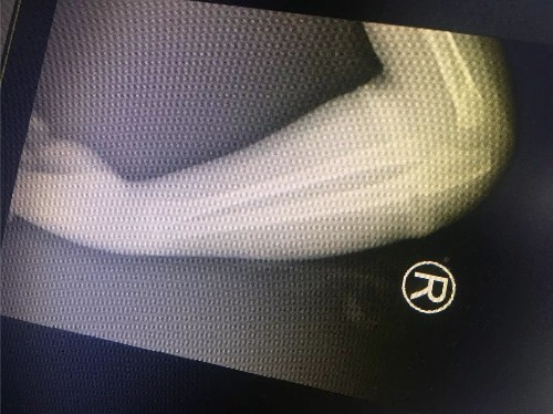 四岁女孩总跟奶奶称胳膊疼,带到医院检查后,医