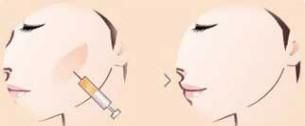  「瘦脸针前」面部轮廓——实现你的V脸明星梦！