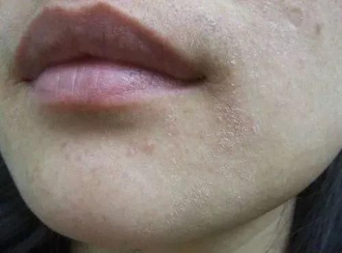 日本祛痘膏竟输给它?第二天痘痘就瘪了，堪比千元修复精华!