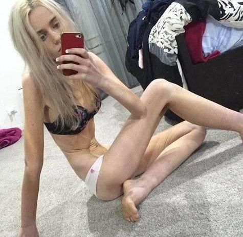 150斤女子因减肥患厌食症，体重剩下70斤，全身上下是骨头!