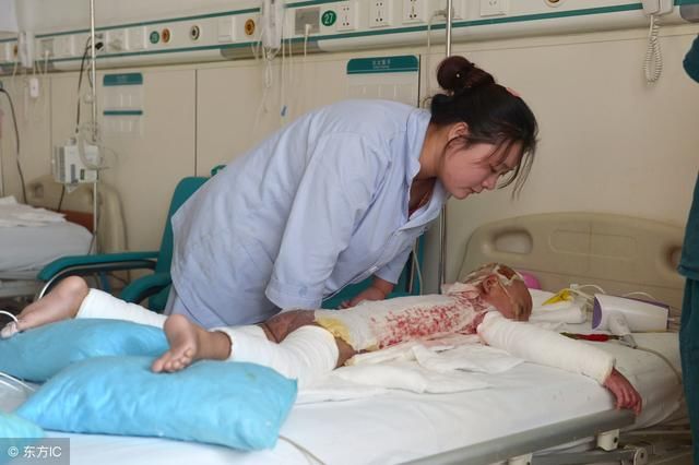 大人忙着大扫除 女婴烫掉一身皮 寒假烫伤高发