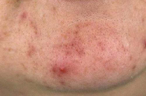 皮肤长满了痘痘粉刺?是螨虫在作怪,该怎么排出来?懊悔知道的太晚