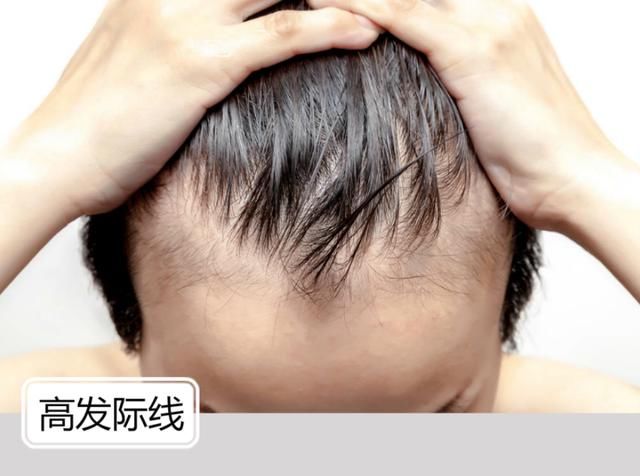  「男生」高发际线的男生别乱剪发型，建议你试试这几款，摆脱高额头更帅气