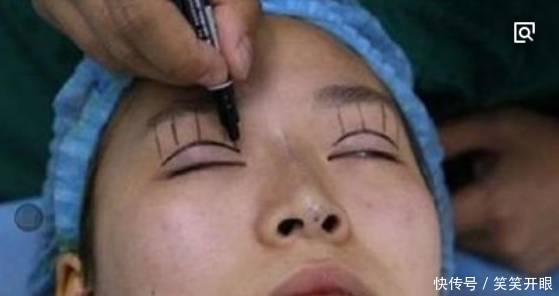 #影响#手术割了双眼皮的人,老了之后有什么影响?看完真要留意了