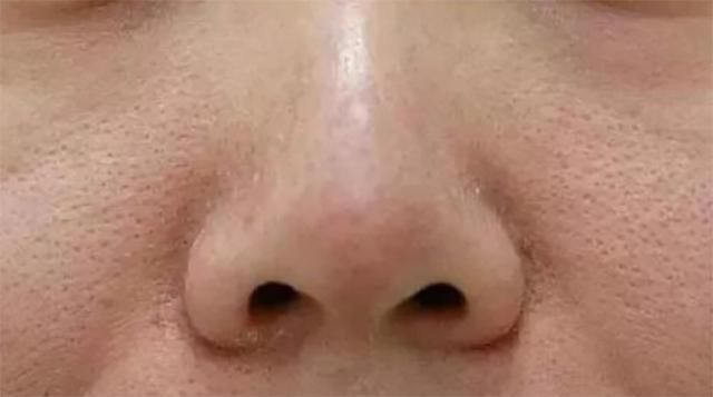 螨虫就是皮肤“祸星”，4异象出现，表示螨虫一步步霸占你的脸