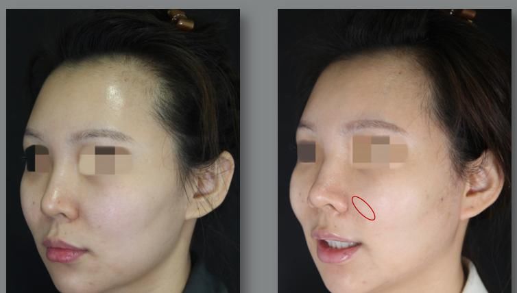  【影响】鼻基底凹陷畸形矫正临床策略及手术对面部表情的影响