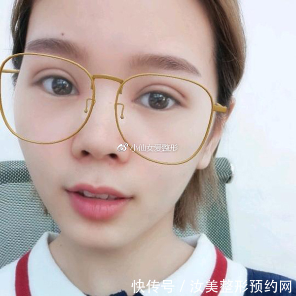 开内眼角前后对比照片，不灵不灵的大眼睛也着实的迷人