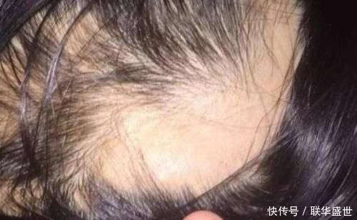  睡觉：睡觉头发“散还是绑”多数女生都搞错了，活该头发“大把掉”