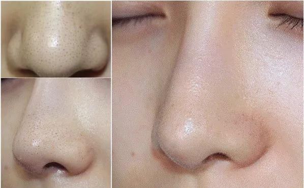 小清新的“脸部吸尘器”,10分钟铲掉你脸上黑头、粉刺、角质!