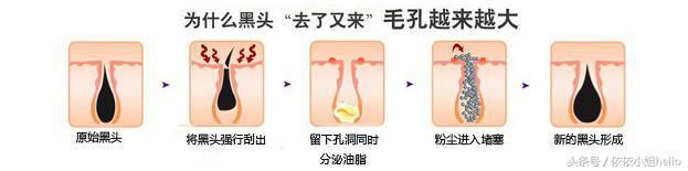 为什么你的黑头越去越多？怎么样去黑头才是正确的呢？