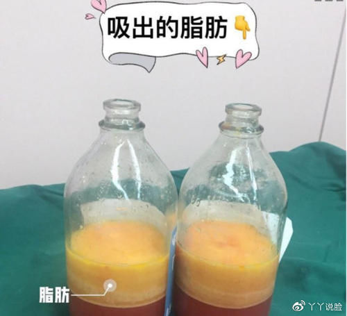  『脂肪细胞』吸脂之前为什么要打肿胀液？吸出来的脂肪是什么样子？