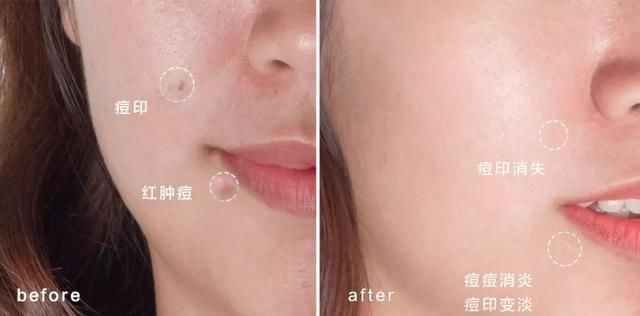 满脸痘怎么见人？用了这个去痘不留印的神器，我把200块的遮瑕都