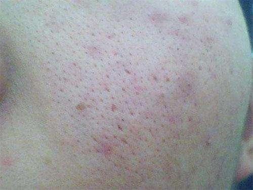 脸上毛孔被螨虫堵住的人，这4大表现逃不掉，2方法排螨虫，缩毛孔