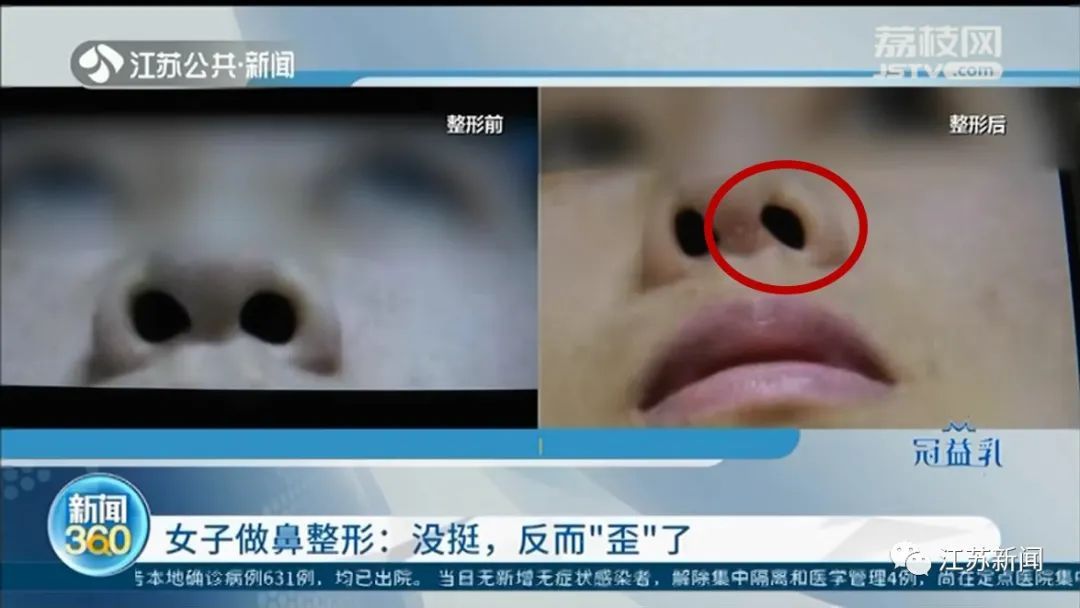  修复@瑟瑟发抖！女子整容后鼻头斜了，修复一下结果鼻孔又歪了！