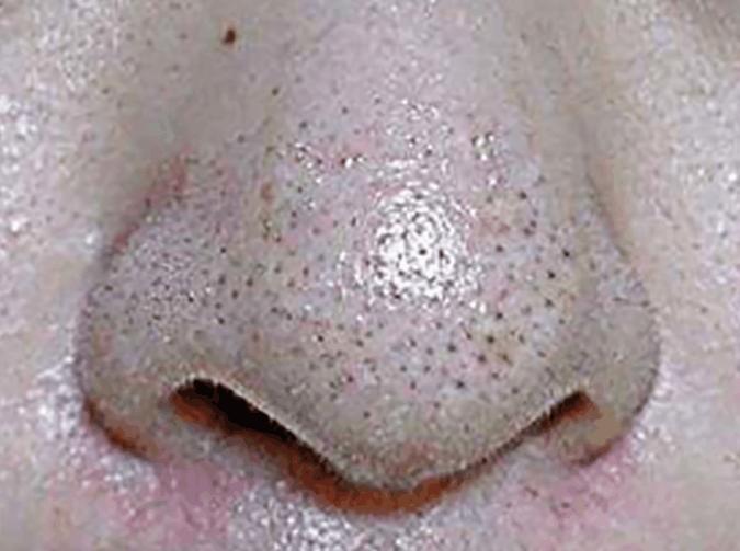 4个异常出现脸部, 十有八九是螨虫, 常用2招除螨, 行之有效