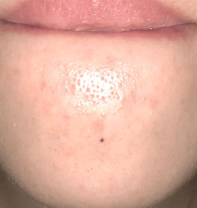 4个异常出现脸部, 十有八九是螨虫, 常用2招除螨, 行之有效