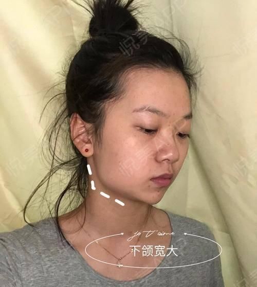  角度■我的下额角磨骨后形成第二个角度,这算不算磨骨失败?
