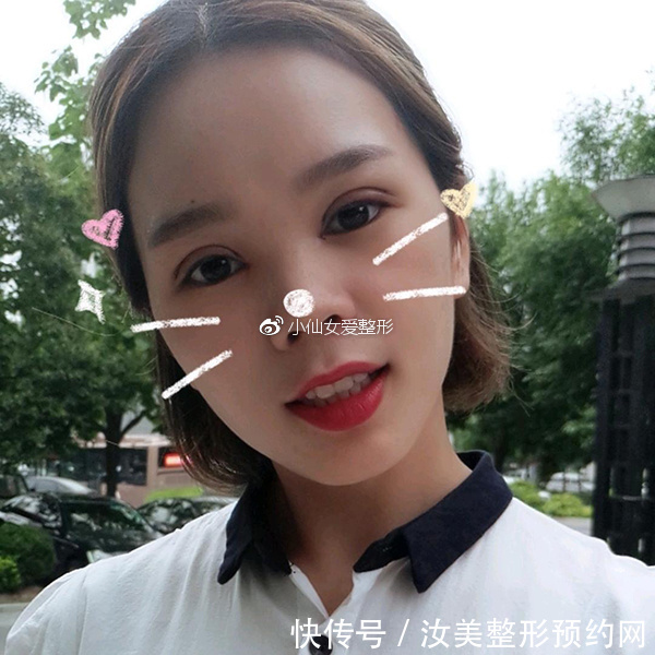 开内眼角前后对比照片，不灵不灵的大眼睛也着实的迷人