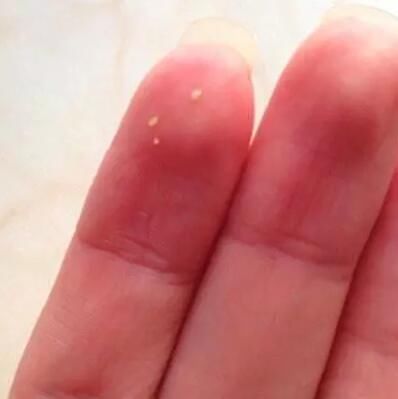 鼻子挤出的小颗粒太多，是螨虫的排泄物凝固，怎么让它们不再长？