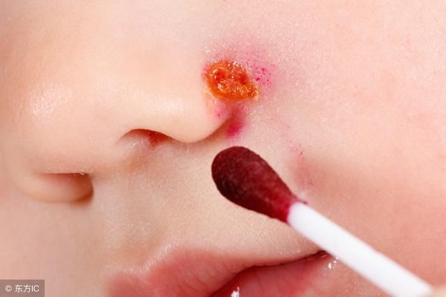 医生忠告：脸上出现4种症状，可能是上万的螨虫