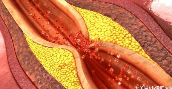 1种食材泡水喝, 连喝30天, 血管的油脂垃圾清一遍