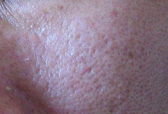 毛孔里反反复复挤出的小米粒，属于螨虫黑头，陨灭螨虫只需2招