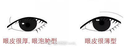 平行和扇形双眼皮该怎么选择？哪个更流行？