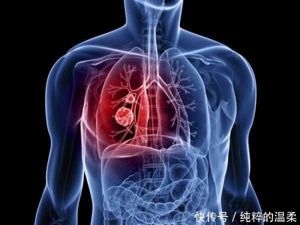  「男子」49岁男子，半年前体检正常，半年后查出肺癌离世体检有用吗