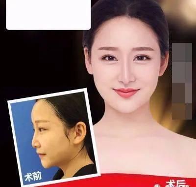  「好看」鼻子做成什么样才好看，一篇务实的鼻修复参考（三）|日本医美