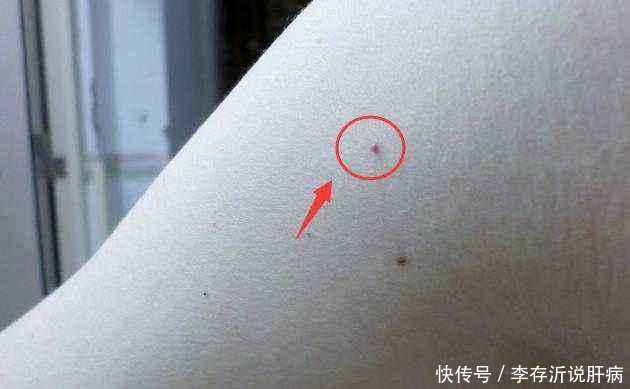 真是案例分享,如何知道自己是不是有酒精肝