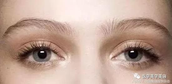 你真的适合“欧式”双眼皮吗？