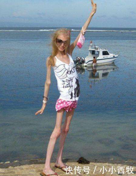 少女因害怕身体走形，每天坚持只喝水不吃食物，如今成“活骷髅”