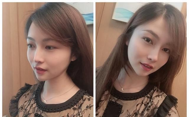  #术后#隆鼻真的有用吗？鼻综合术后六个月记录，这完全不是一个人！