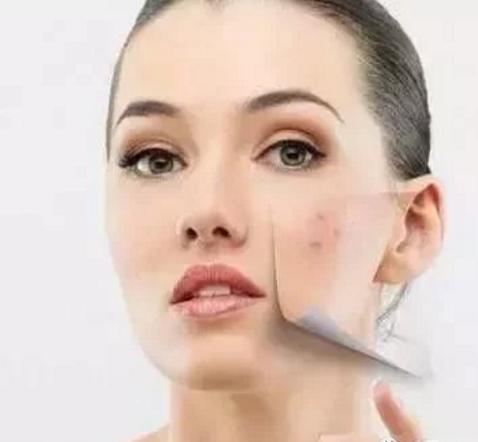 螨虫天天在脸上打洞,用这1招,脸蛋变得白白净净,开开心心等待开学