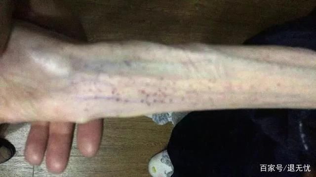 21岁女孩体重50斤，两次脑出血，都是减肥惹的祸！