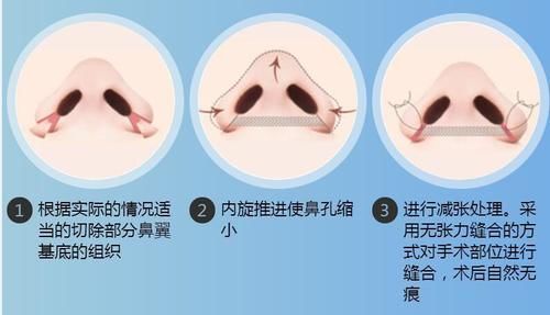 [医生]鼻翼缩小手术安全吗？有什么需要注意的？