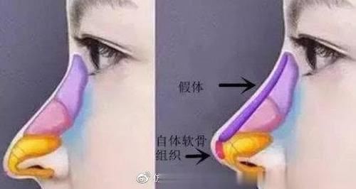 『手术』鼻部整形常见困惑解答
