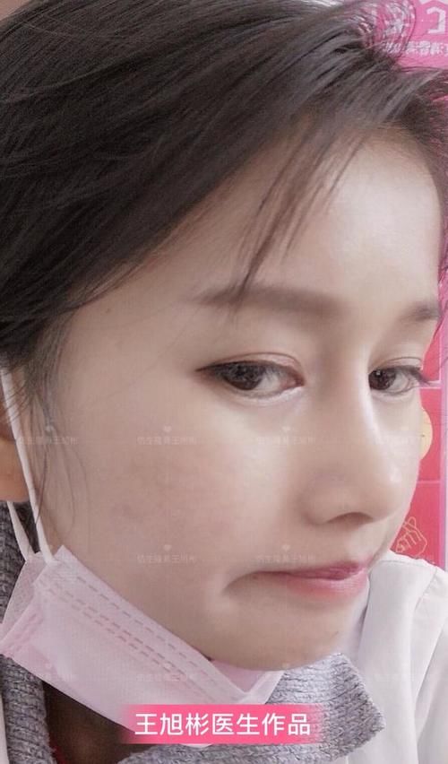  术后■鼻头肥大、山根低、没鼻梁，肋软骨隆鼻后变化有多大？